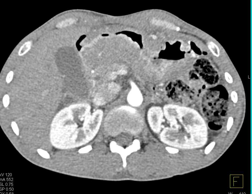 Gastric Adenocarcinoma - CTisus CT Scan