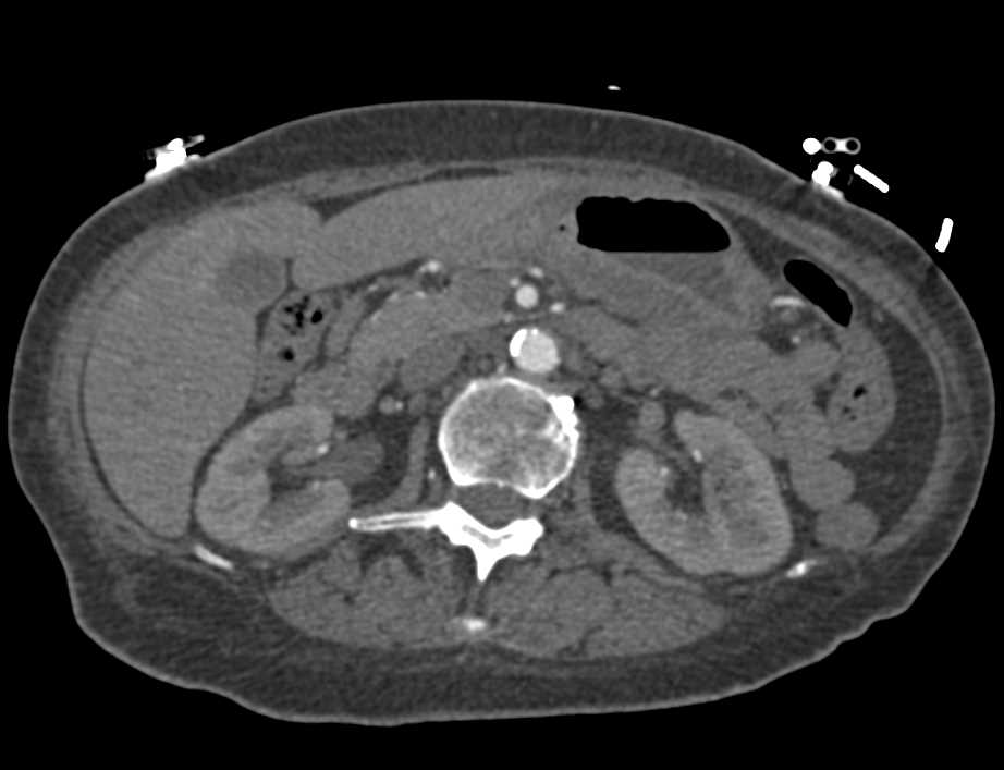 Gastric Adenocarcinoma - CTisus CT Scan