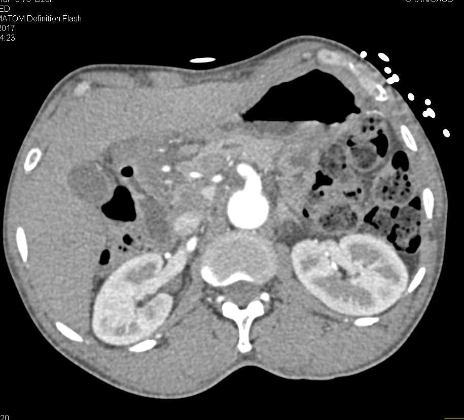 Gastric Adenocarcinoma - CTisus CT Scan