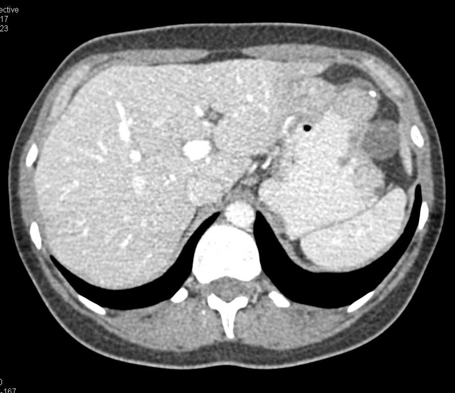 Multiple Gastric GIST Tumors - CTisus CT Scan