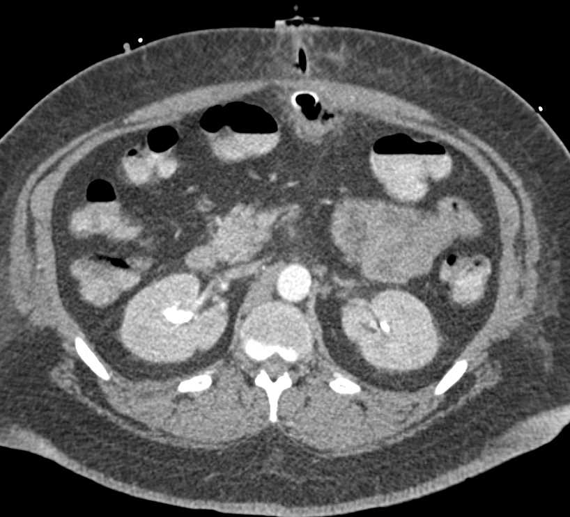 G-Tube in the Abdominal Wall - CTisus CT Scan