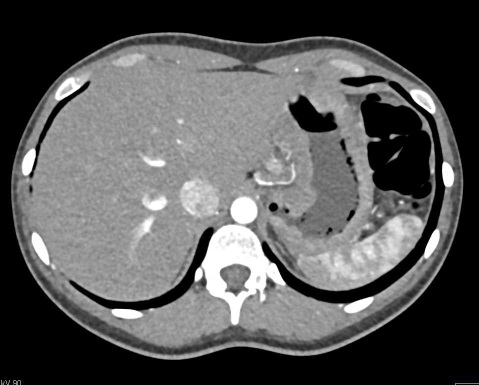 Infiltrating Gastric Adenocarcinoma - CTisus CT Scan