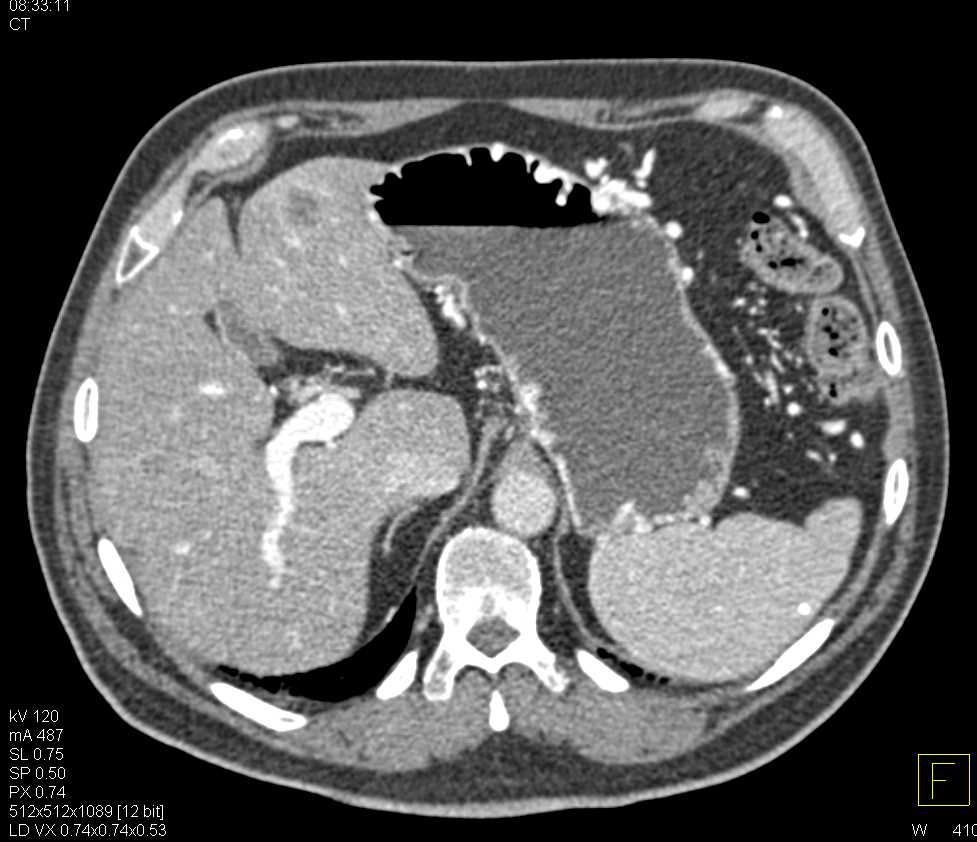 Gastric Cancer with Liver Metastases - CTisus CT Scan