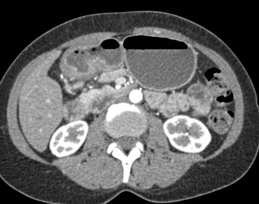 Infiltrating Carcinoma of the Gastric Antrum - CTisus CT Scan