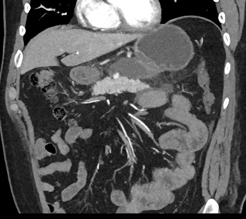 Gastric Adenocarcinoma - CTisus CT Scan