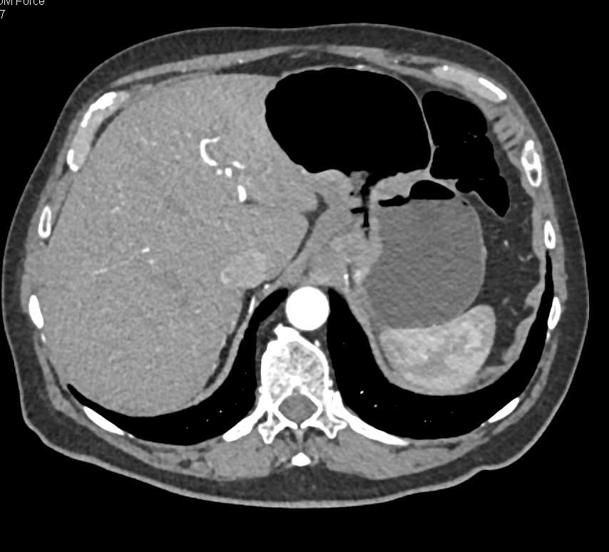 Gastric Adenocarcinoma in the Body of the Stomach - CTisus CT Scan