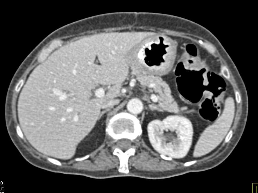 Gastric Adenocarcinoma with Stent - CTisus CT Scan