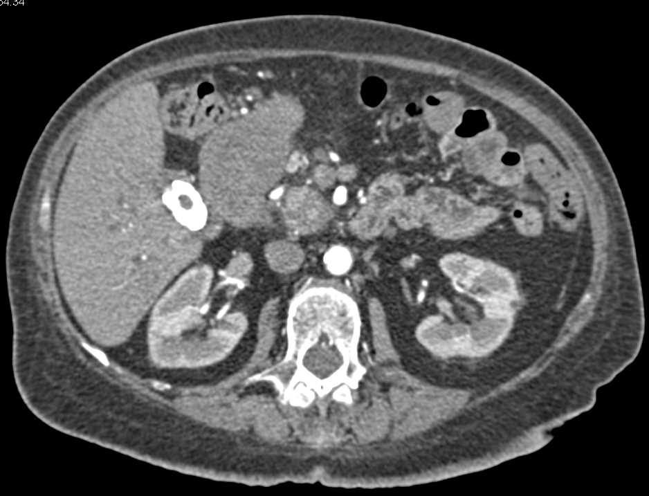 Gastric Adenocarcinoma Extends into the Duodenum - CTisus CT Scan