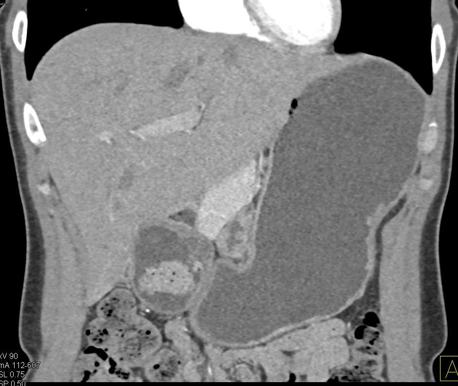 Residual Food Matter in the Antrum - CTisus CT Scan