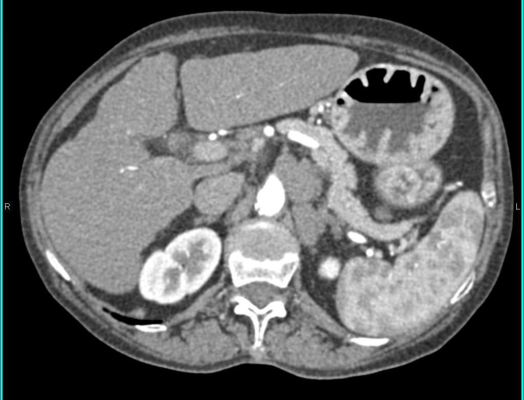 Gastrinoma with Thickened Gastric Folds - CTisus CT Scan