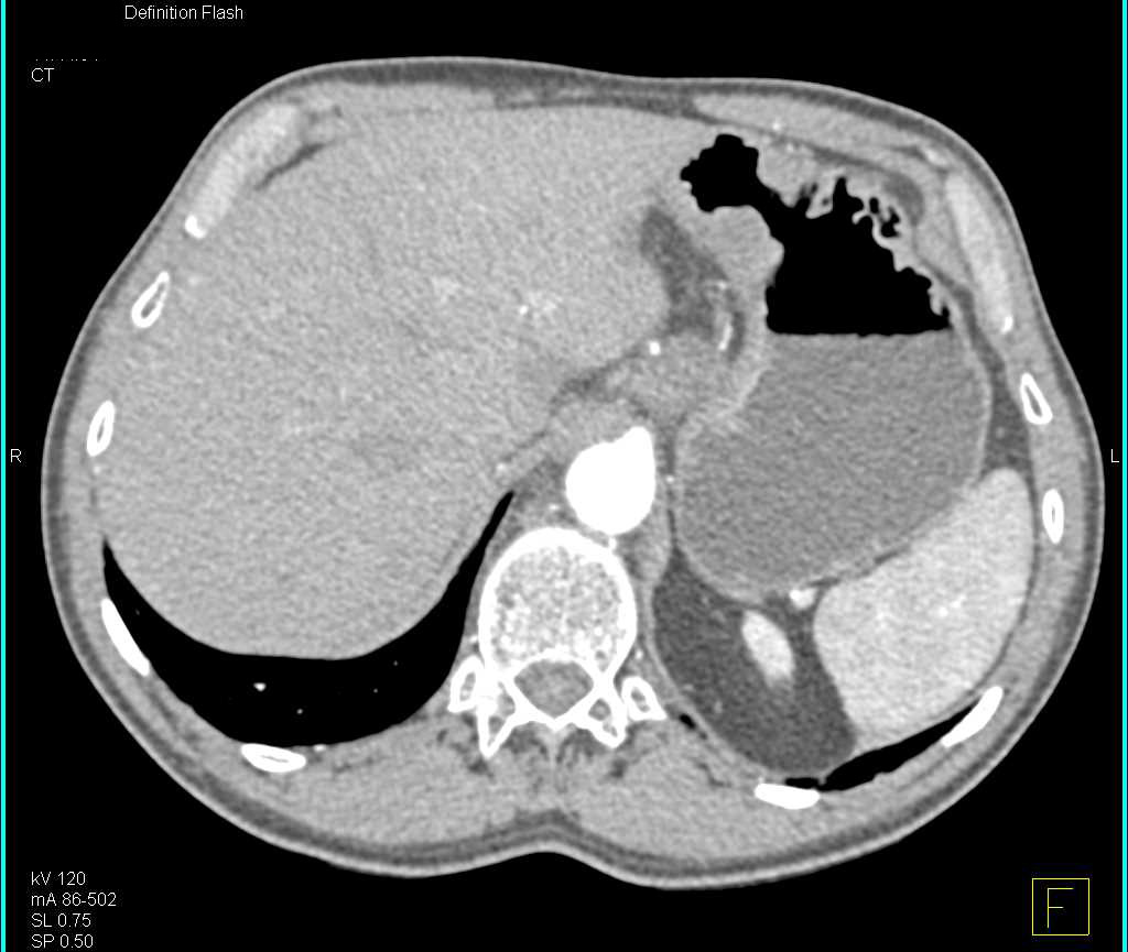 Gastric Cancer with Liver Metastases and Carcinomatosis - CTisus CT Scan