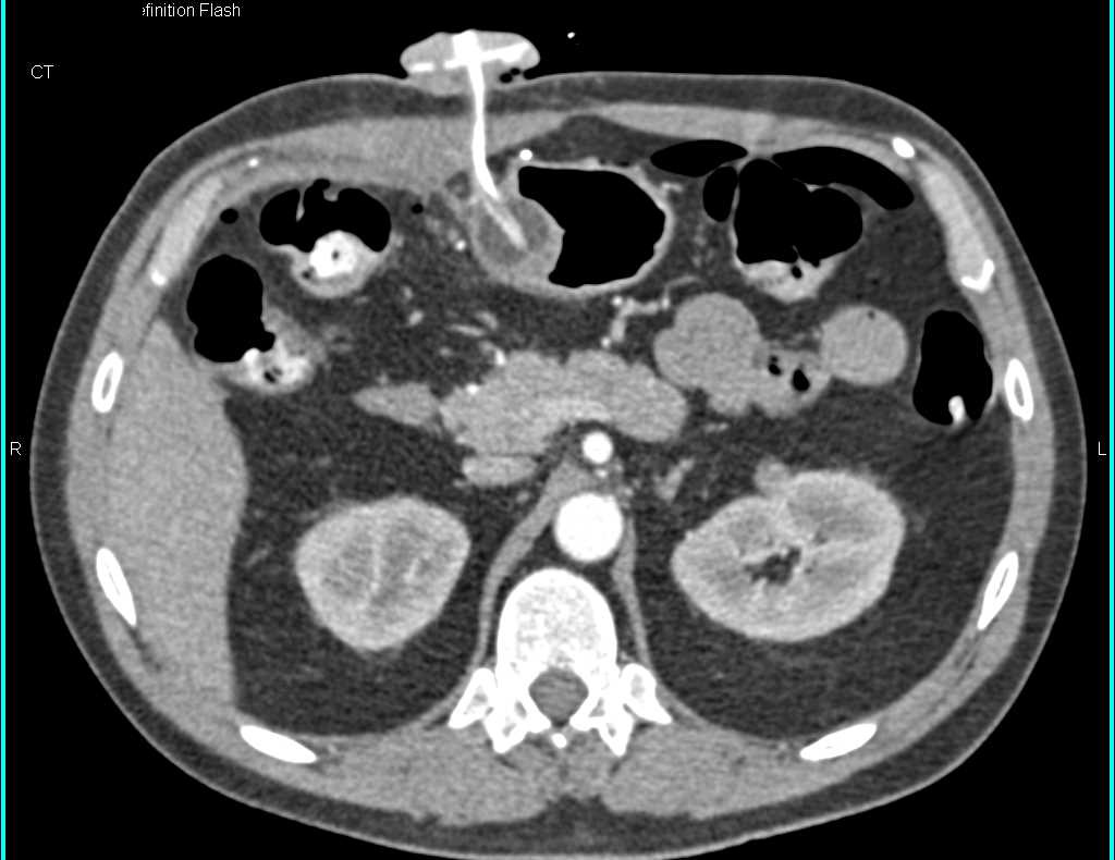 G-Tube in the Stomach - CTisus CT Scan