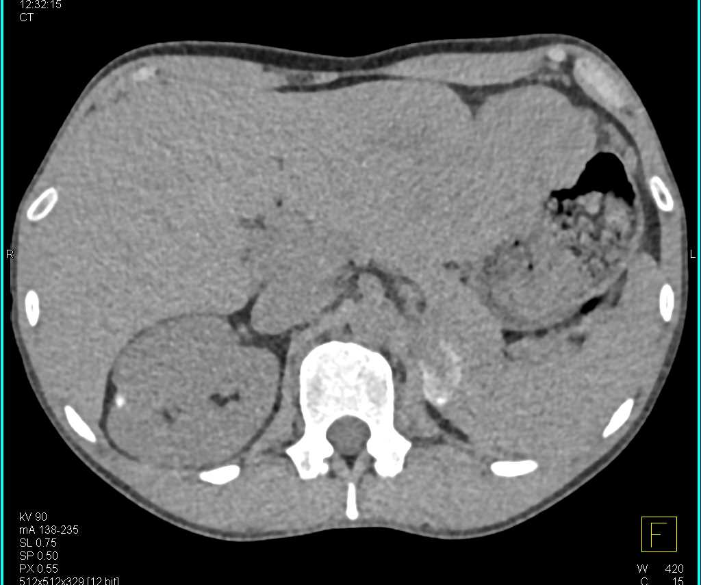 GIST Tumor Stomach - CTisus CT Scan