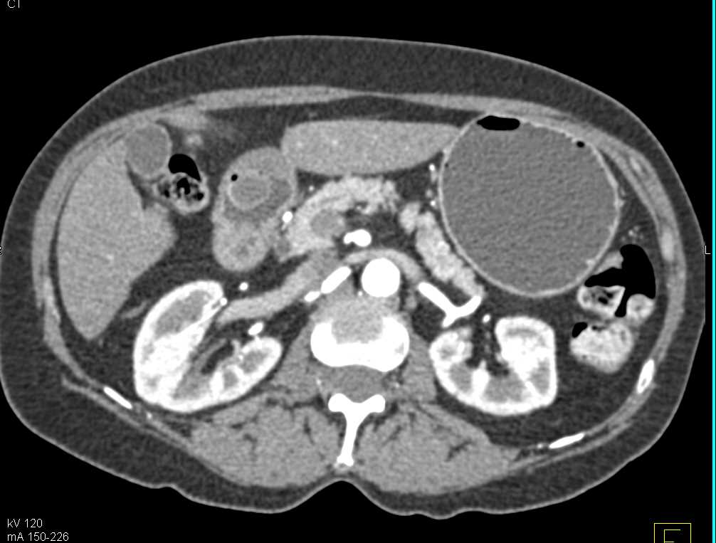 Cyst in the Gastric Antrum - CTisus CT Scan