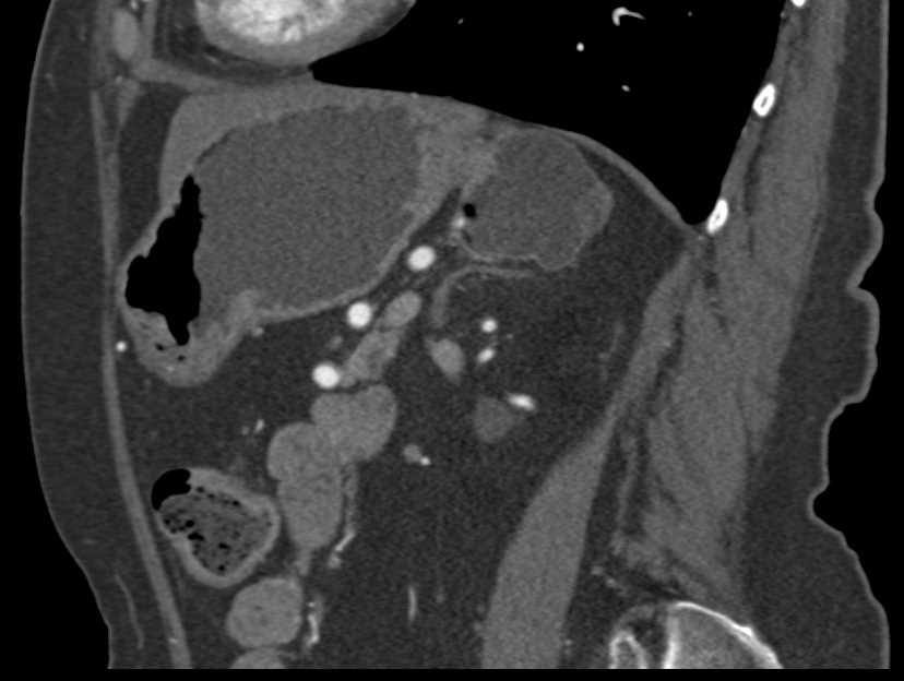 Gastric Diverticulum - CTisus CT Scan