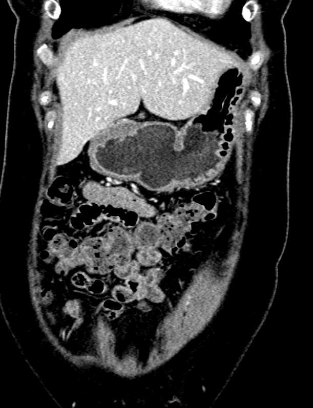 Thickening of the Gastric Antrum - CTisus CT Scan