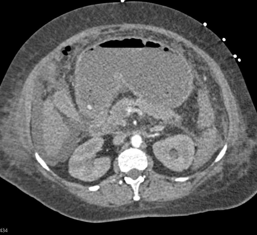 Carcinomatosis with Gastric Outlet Obstruction - CTisus CT Scan