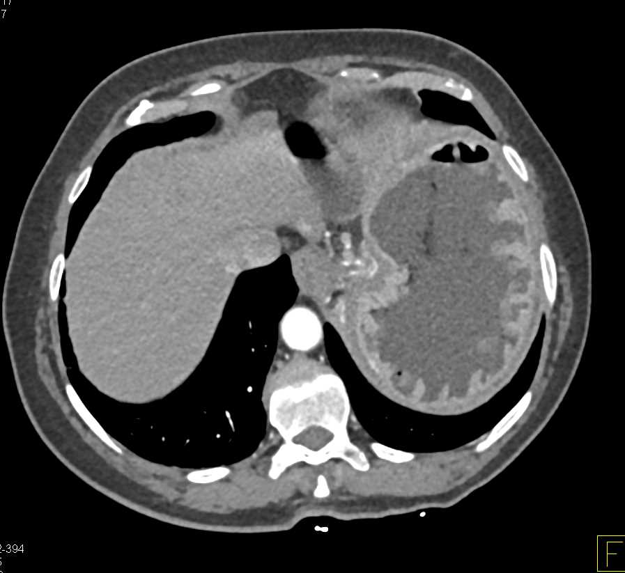 Multiple Polypoid Tumors in the Patients Stomach - CTisus CT Scan