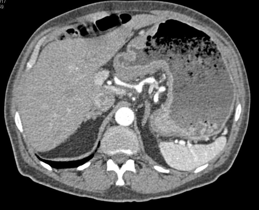 Antral Carcinoma and Incidental Chronic Pancreatitis - CTisus CT Scan