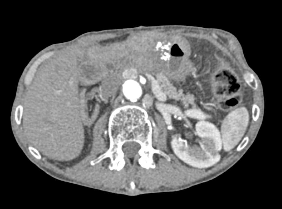 Infiltrating Gastric Adenocarcinoma - CTisus CT Scan