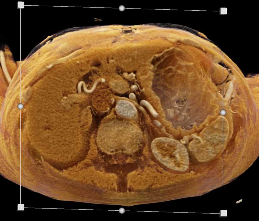 Infiltrating Gastric Adenocarcinoma with Carcinomatosis - CTisus CT Scan