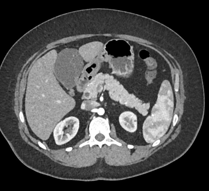 Antral Carcinoma - CTisus CT Scan