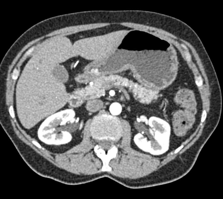 Bleeding Ulcer in the Gastric Antrum - CTisus CT Scan