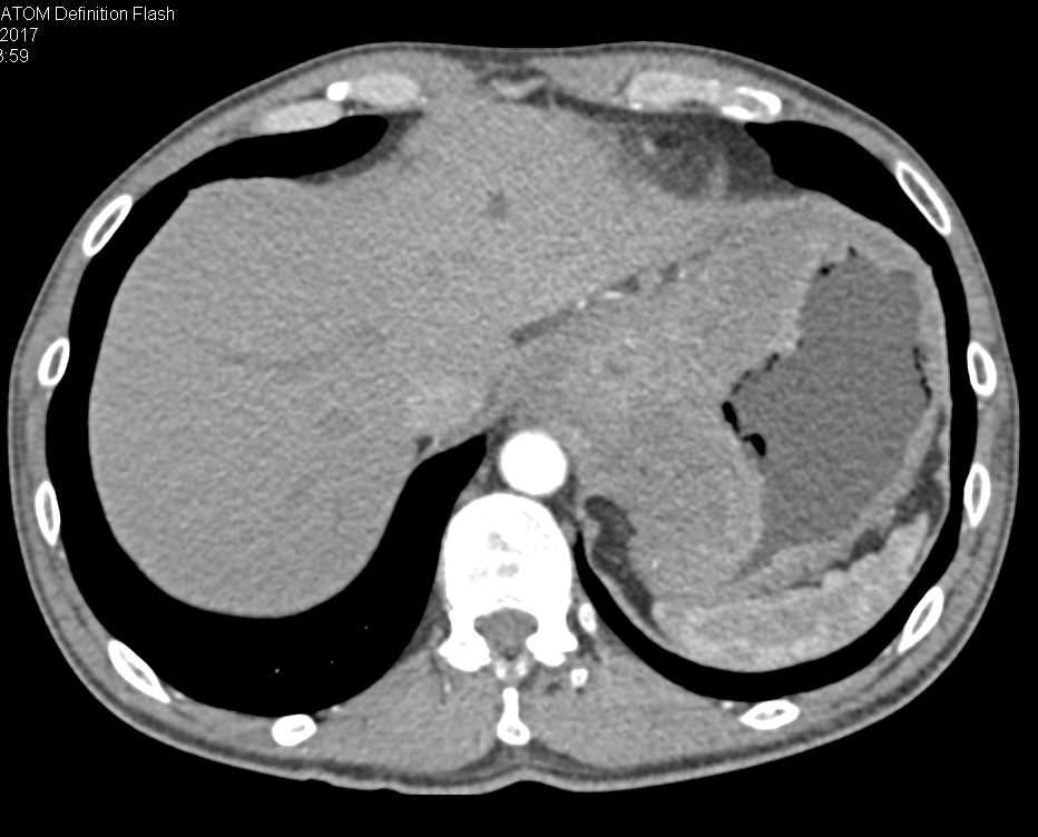 Bulky Gastric Adenocarcinoma with Adenopathy - CTisus CT Scan