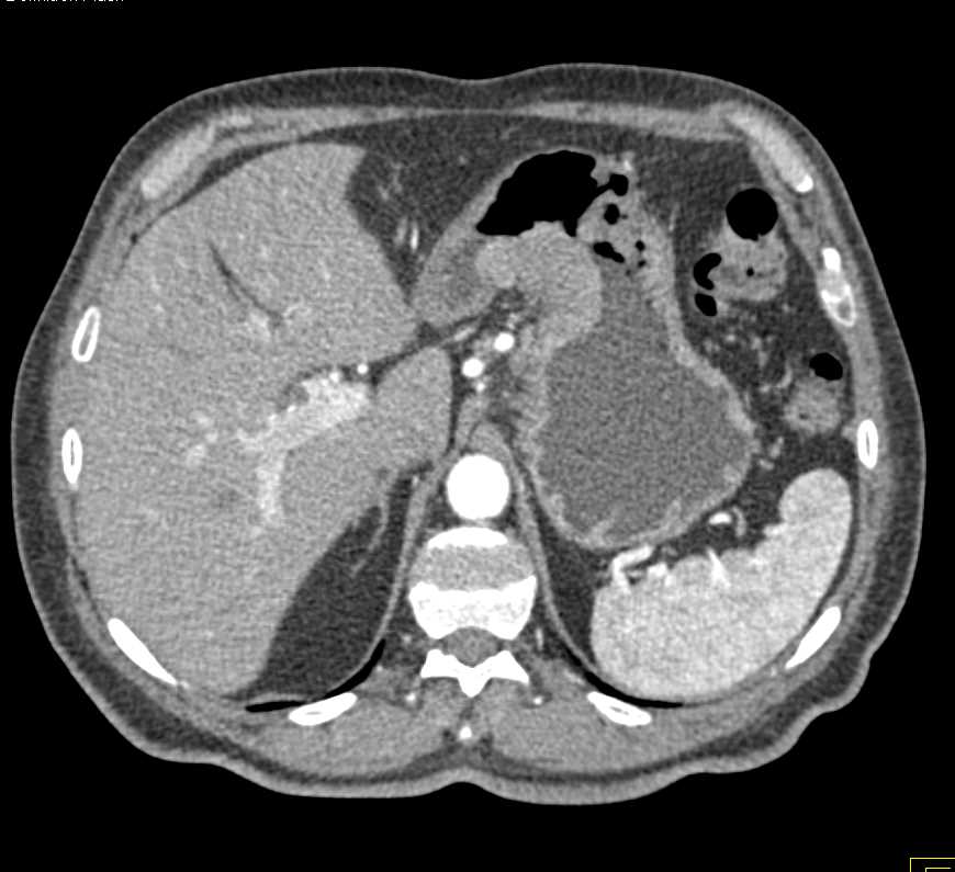 Carcinoma Gastric Antrum - CTisus CT Scan