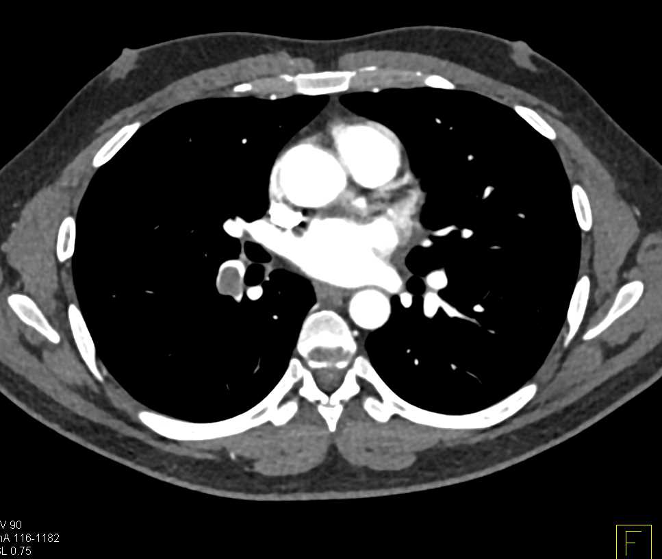 Incidental Pulmonary Embolism (PE) in a Patient with Gastric Cancer - CTisus CT Scan