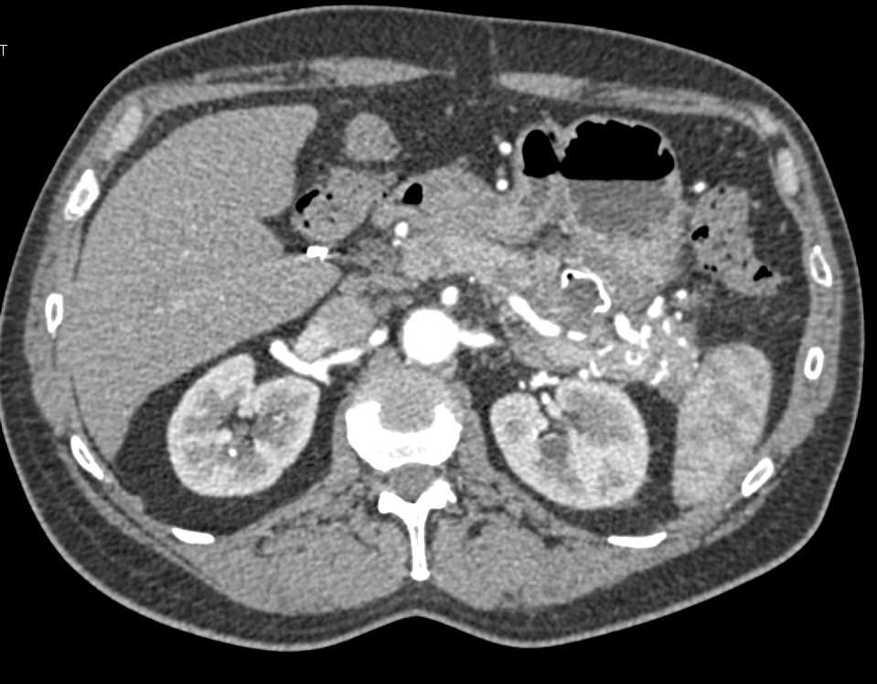 Pancreatitis with Cystgastrostomy - CTisus CT Scan