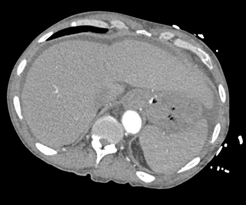 Active Bleed with Blood in the Stomach - CTisus CT Scan