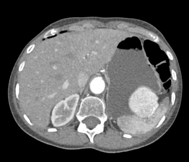 Gastric GIST Tumor - CTisus CT Scan