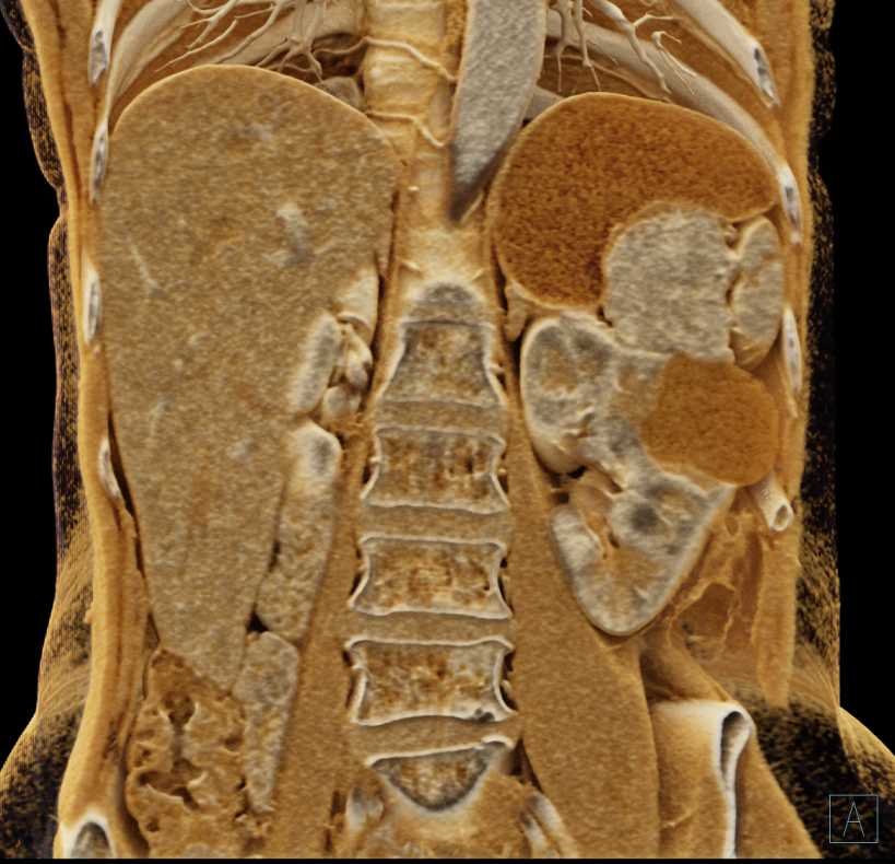 Gastric GIST Tumor with Cinematic Rendering - CTisus CT Scan