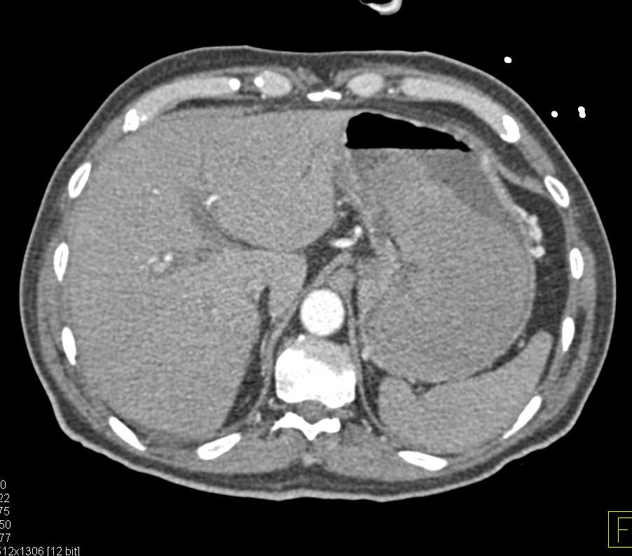 Gastric Bleed with Pseudoaneurysms - CTisus CT Scan