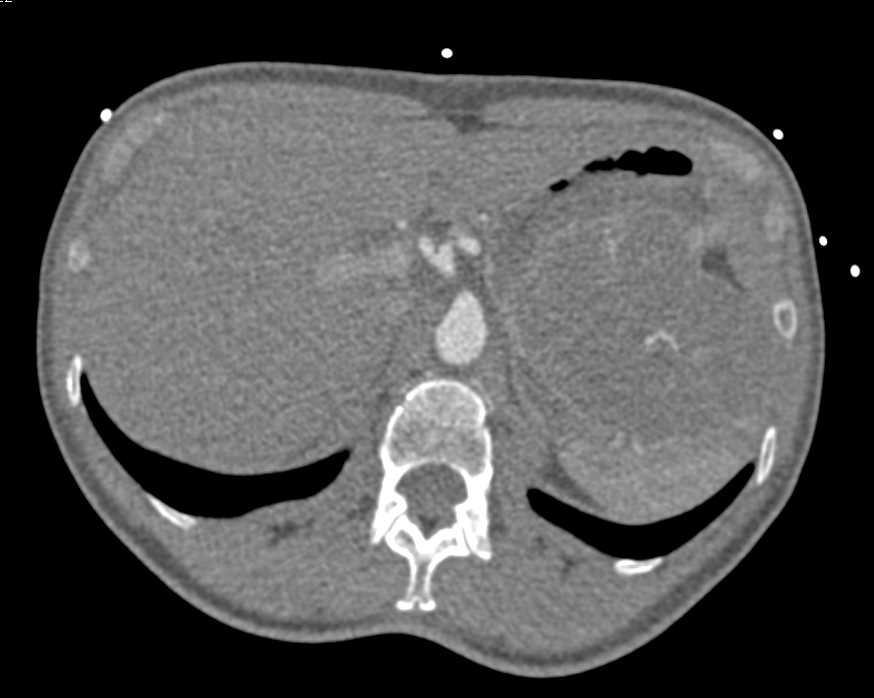 Gastric GIST Tumor - CTisus CT Scan