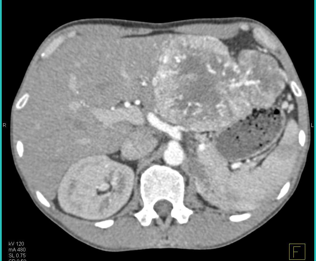 Gastric GIST Tumor with Vascular Tumor - CTisus CT Scan