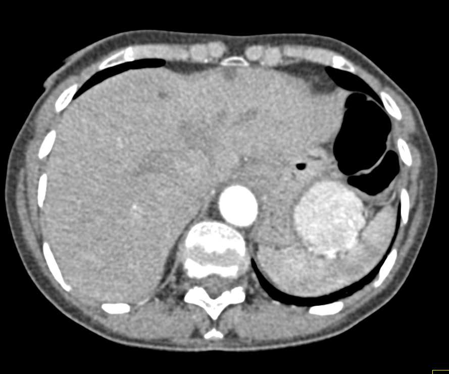 Gastric GIST Tumor - CTisus CT Scan