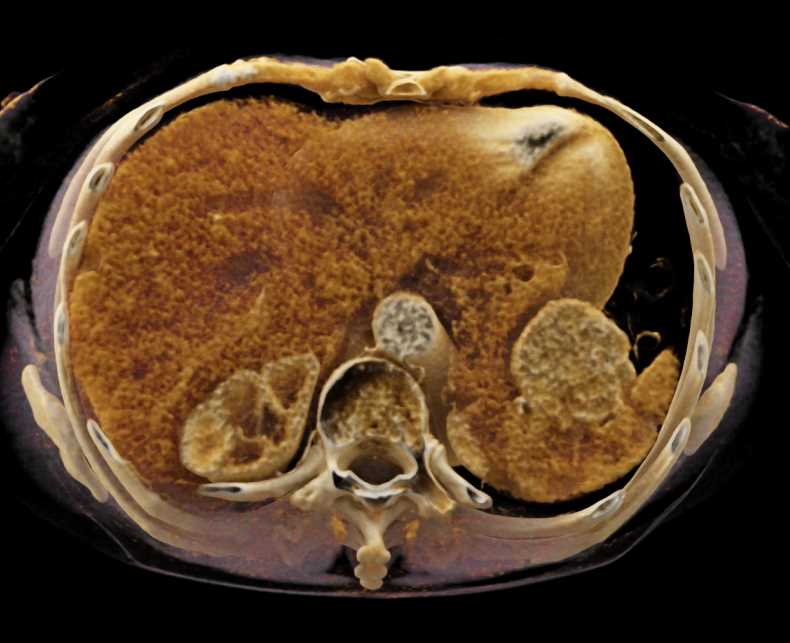 Gastric GIST Tumor - CTisus CT Scan