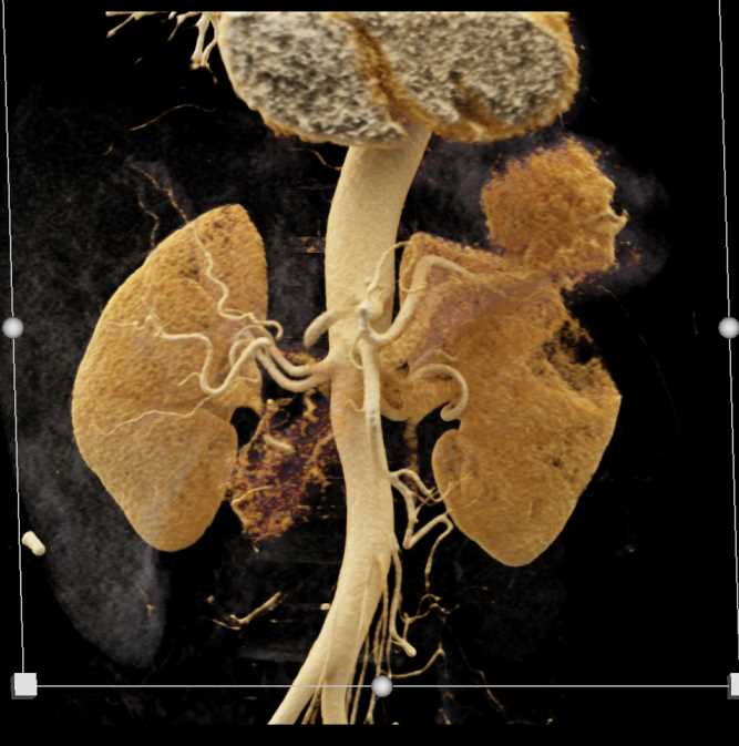 Gastric GIST Tumor - CTisus CT Scan