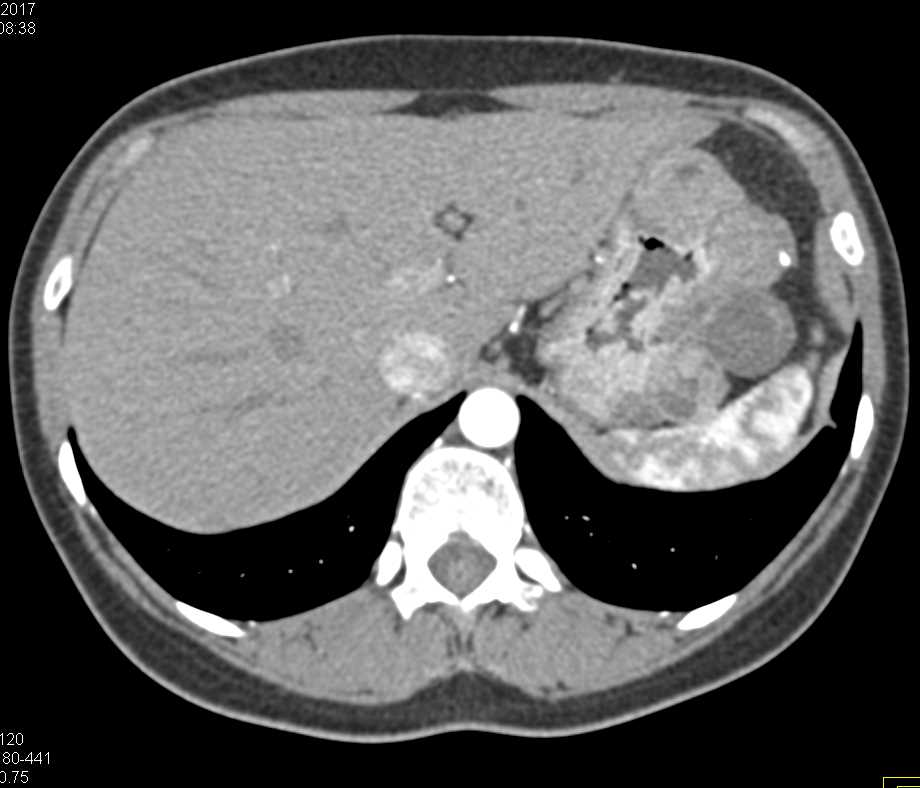 Multiple Gastric GIST Tumors - CTisus CT Scan