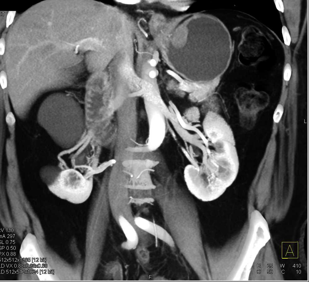 Gastric GIST Tumor - CTisus CT Scan