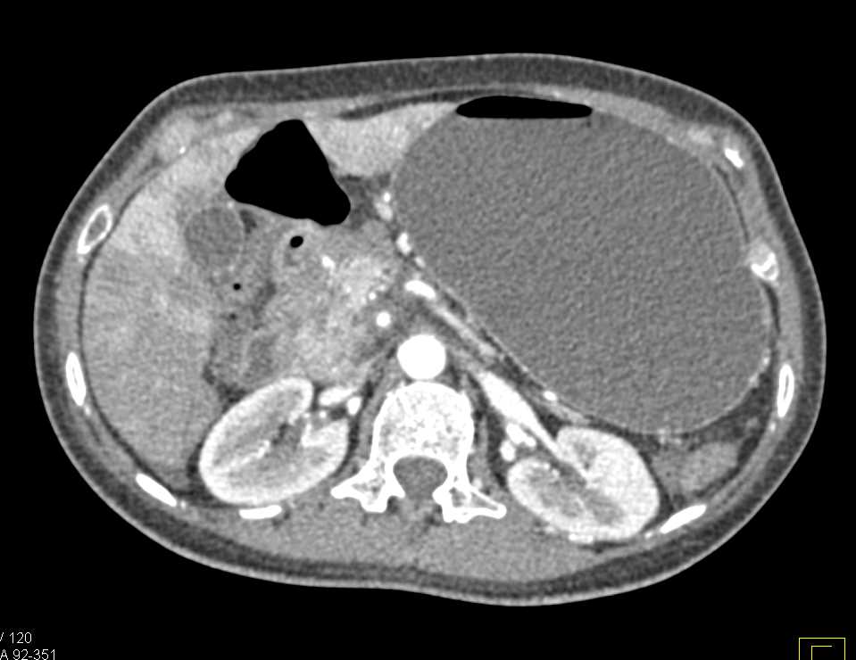 Gastric Outlet Obstruction caused by Pancreatic Adenocarcinoma - CTisus CT Scan