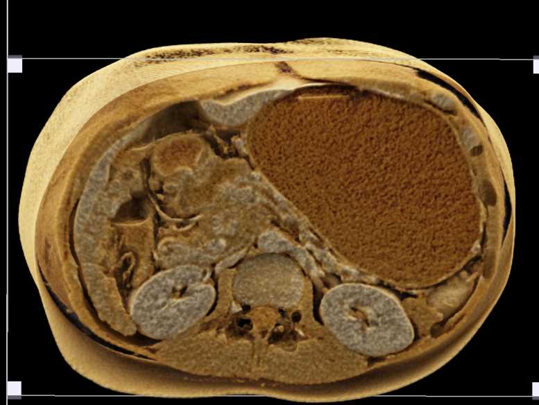 Gastric Outlet Obstruction caused by Pancreatic Adenocarcinoma - CTisus CT Scan