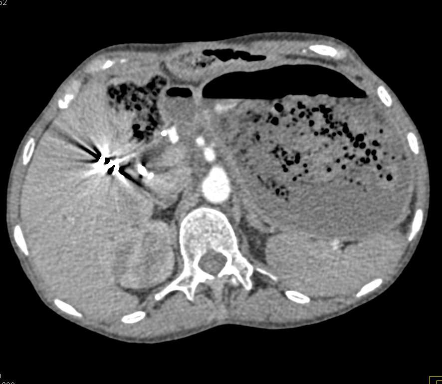 Gastric Outlet Obstruction - CTisus CT Scan