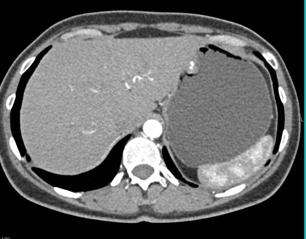 1cm Calcified GIST Stomach - CTisus CT Scan