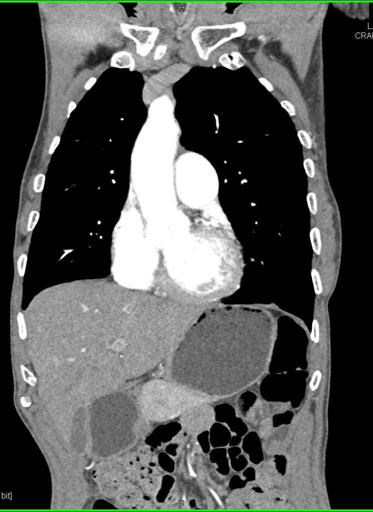 Gastric GIST Tumor - CTisus CT Scan