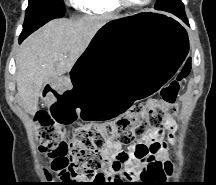 Antral Gastric Adenocarcinoma - CTisus CT Scan