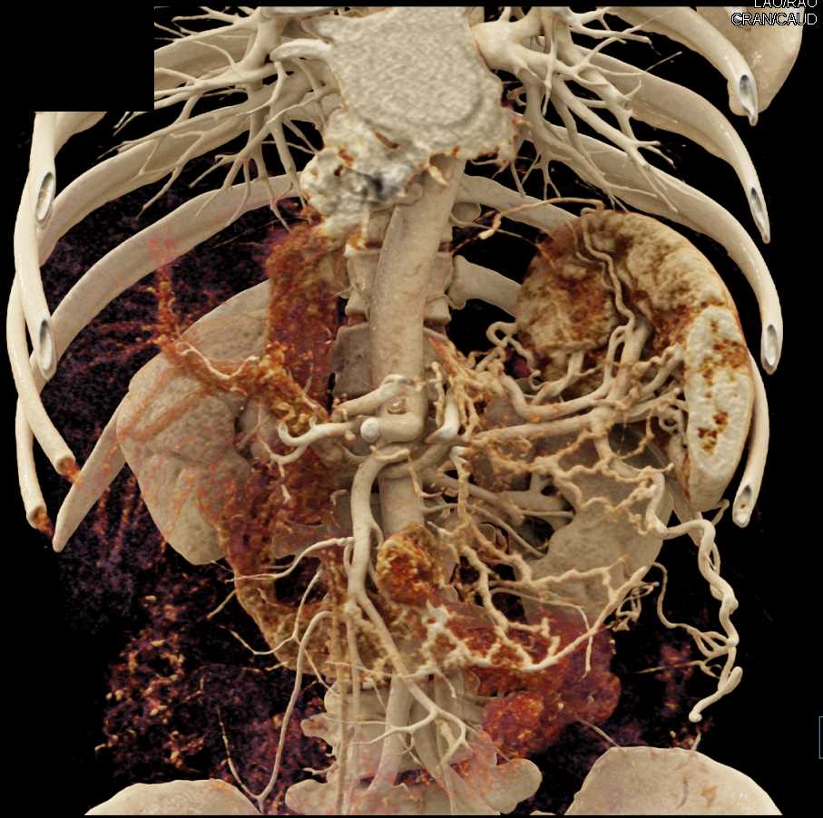 Gastric Cancer with Prominent Folds and Vessels - CTisus CT Scan