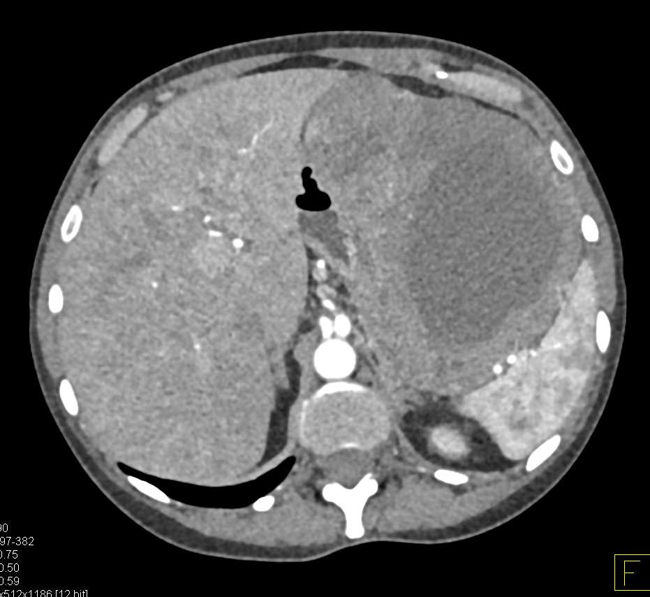 Gastric GIST Tumor - CTisus CT Scan